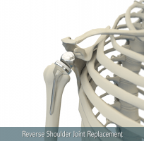 Reverse Shoulder Relacement
