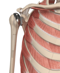 Shoulder Replacement